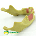 IMPLANT08 (12619) Oral Implant Dental Training Modell für fehlende Zahnimplantate